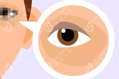 黑眼圈眼袋示意图