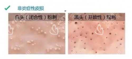 非炎症性闭口闭口黑口