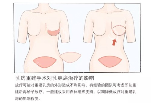 乳房重建手术图片一览