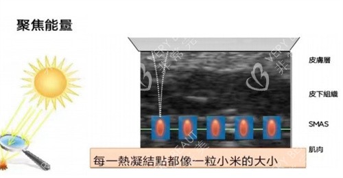 超声王单点释能
