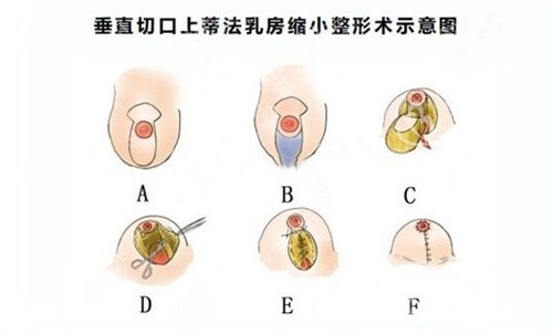 缩胸手术