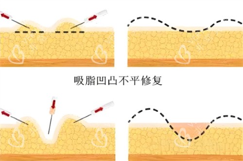 吸脂术后皮肤凹凸不平