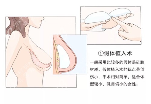乳房重建手术图片