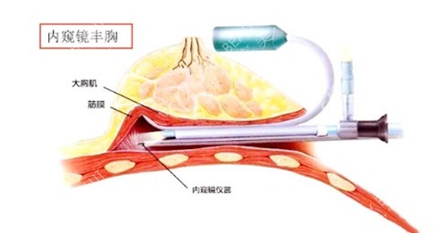 丰胸卡通图