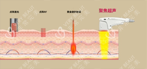尖峰超声王作用皮肤层次透视图