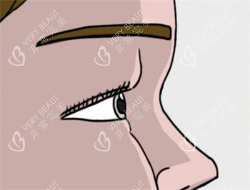 肿眼泡单眼皮示意图
