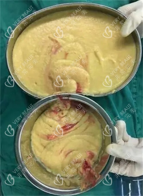 胸部不明注射物取出