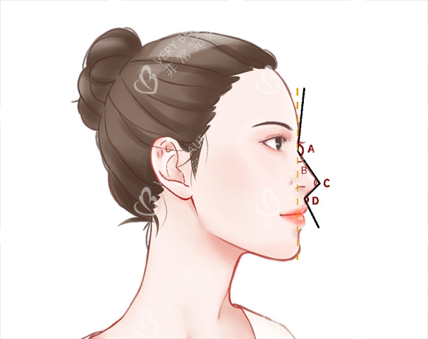 鼻尖塑形