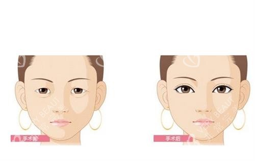 开眼角前后<span style=