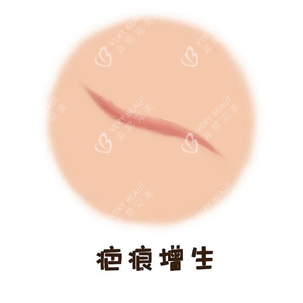 疤痕增生图片