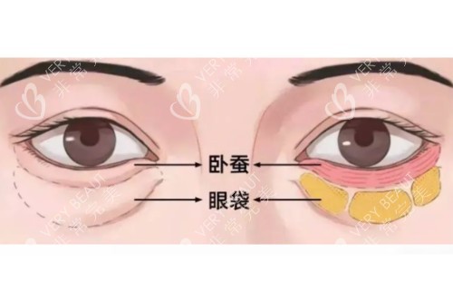 眼袋、卧蚕区分图