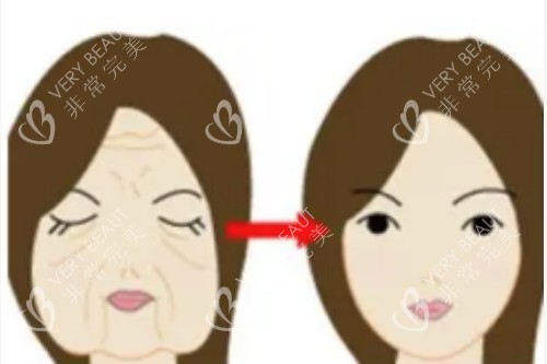 脸部衰老提升对比图
