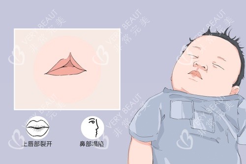 上海甘泉涌唇腭裂症状图