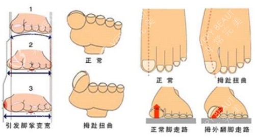 拇指外翻示意图