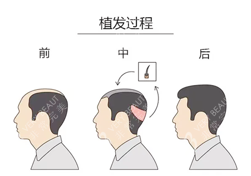 植发过程图示