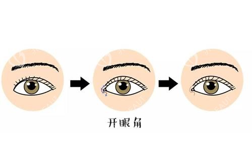 开眼角前后对比漫画图