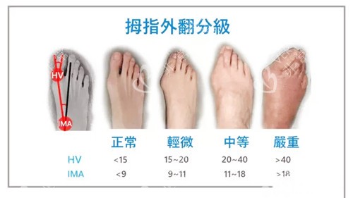 拇指外翻图
