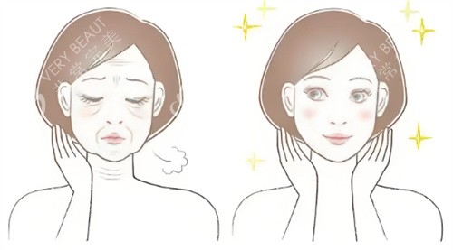 脸部抗衰前后对比