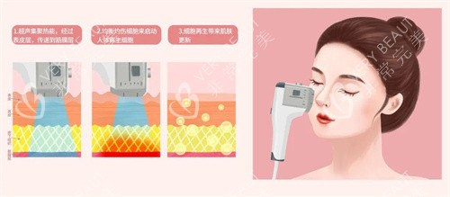 超声炮面部操作示意图