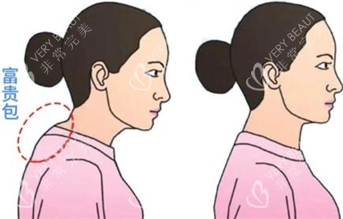 海口星之美富贵包去除前后对比