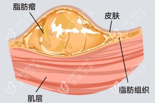 脂肪瘤所在皮肤层面示意图