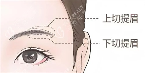 提眉术式区别