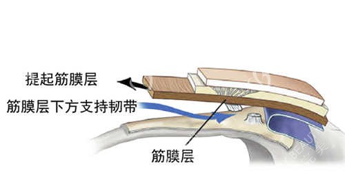 SMAS筋膜层图片展示