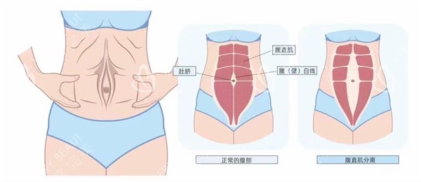 腹直肌分离解析图