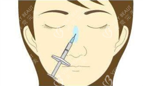 注射隆鼻正面