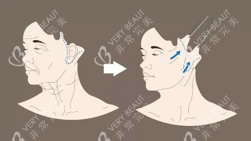 张海明医生做韧带拉皮示意图