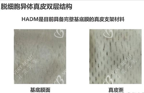 3d生物束带紧缩术材料结构示意图