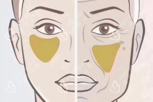 苹果肌下垂卡通对比图