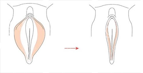 女性私密手术外阴动画展示