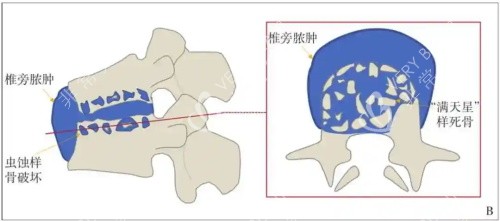 脊柱损伤展示示意图