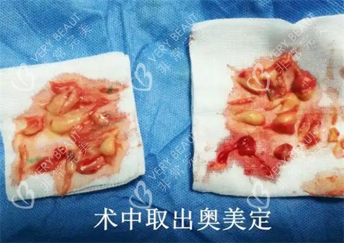 术中取出的奥美定