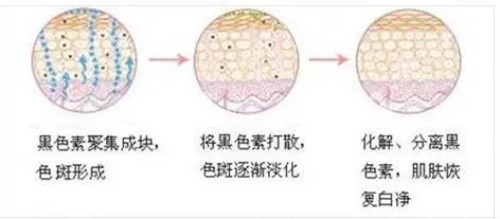 韩国shinebeam皮肤科激光祛斑示意图