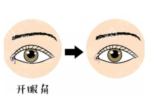 开眼角对比图