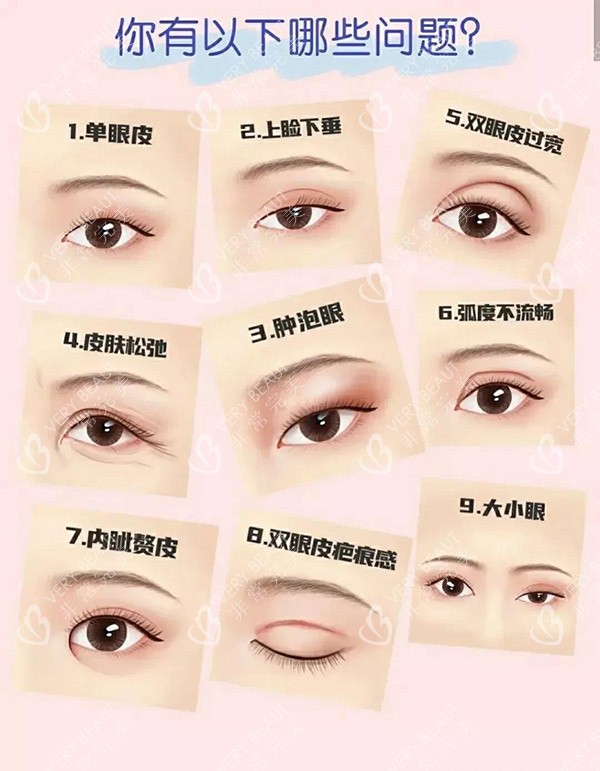 雙眼皮類(lèi)型圖片