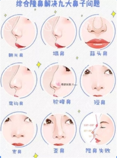 隆鼻