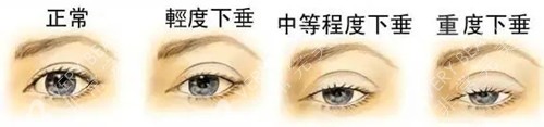上瞼下垂分級(jí)