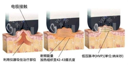 inmode原理展示图