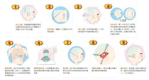 擴張器法耳再造手術(shù)動畫演示圖