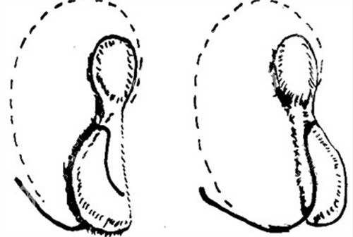 小耳再造手術(shù)