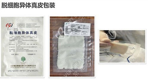 3d生物束帶緊縮術(shù)材料包裝示意圖