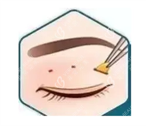 雙眼皮三點(diǎn)術(shù)圖