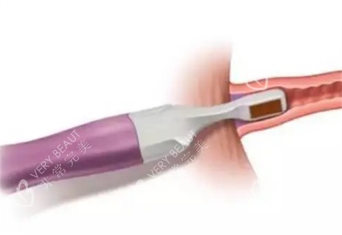 viveve薇蜜私密紧致仪器治疗过程图解