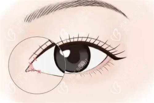 開(kāi)眼角手術(shù)動(dòng)畫(huà)圖示