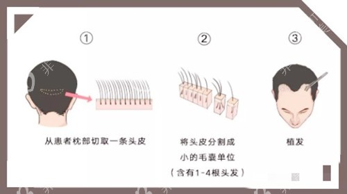 头发移植图示