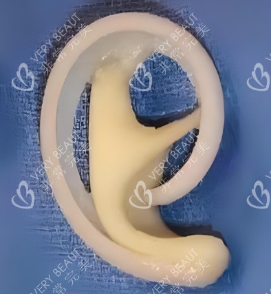 耳再造手術(shù)假體照片