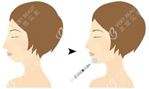 注射墊下巴前后的區(qū)別